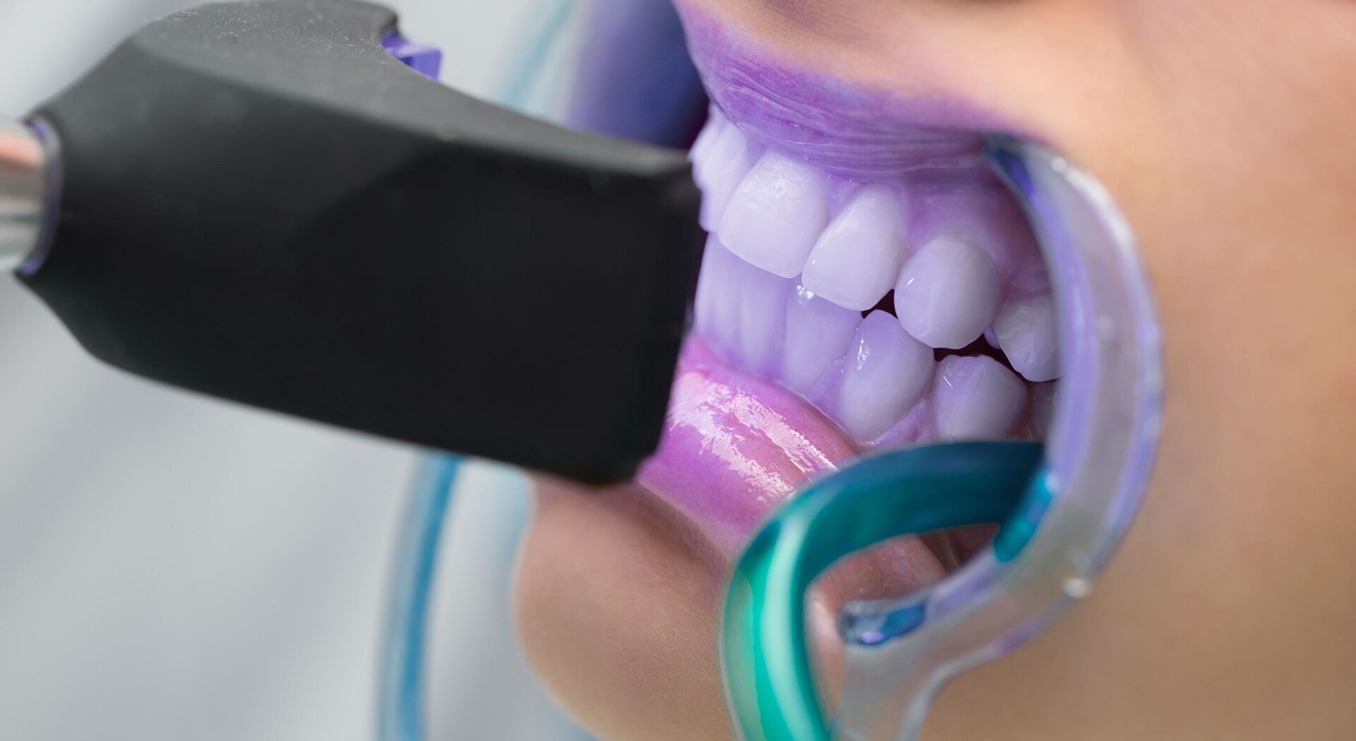 Séance de blanchiment en cabine